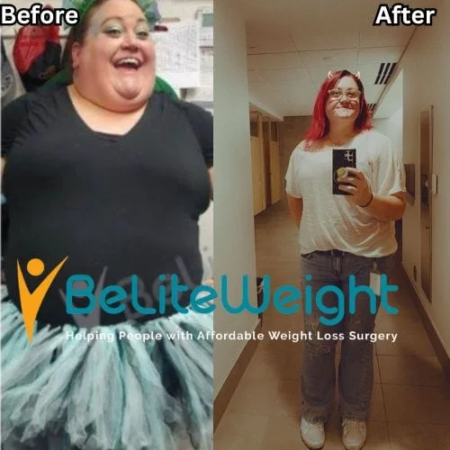 RNY Gastric Bypass Before and After Weight Loss Surgery Before and After